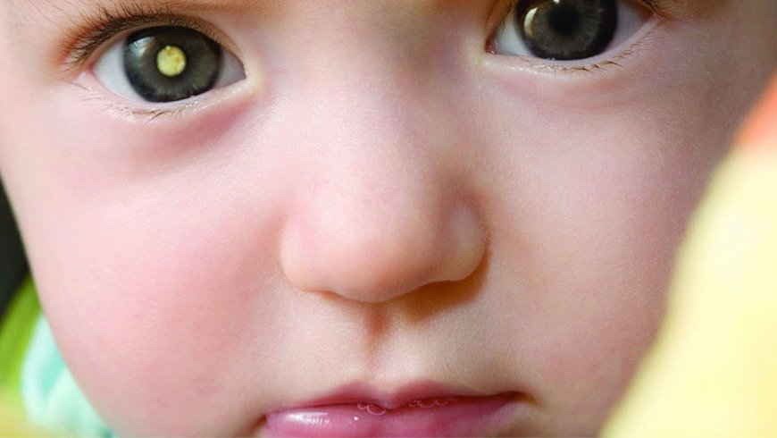 Retinoblastoma: cáncer ocular agresivo es más frecuente en niños