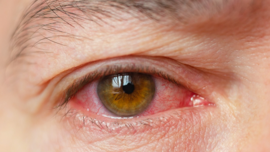 Conoce cómo la bacteria Pseudomona puede afectar a la visión