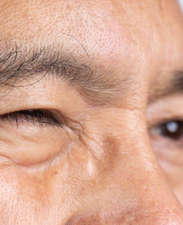 Visión borrosa que mejora al parpadear